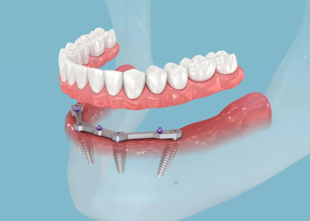 All-On-4-implant