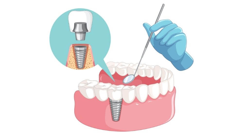 implant-tedavisi-izmir