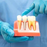 implant-sonrasi-beslenme