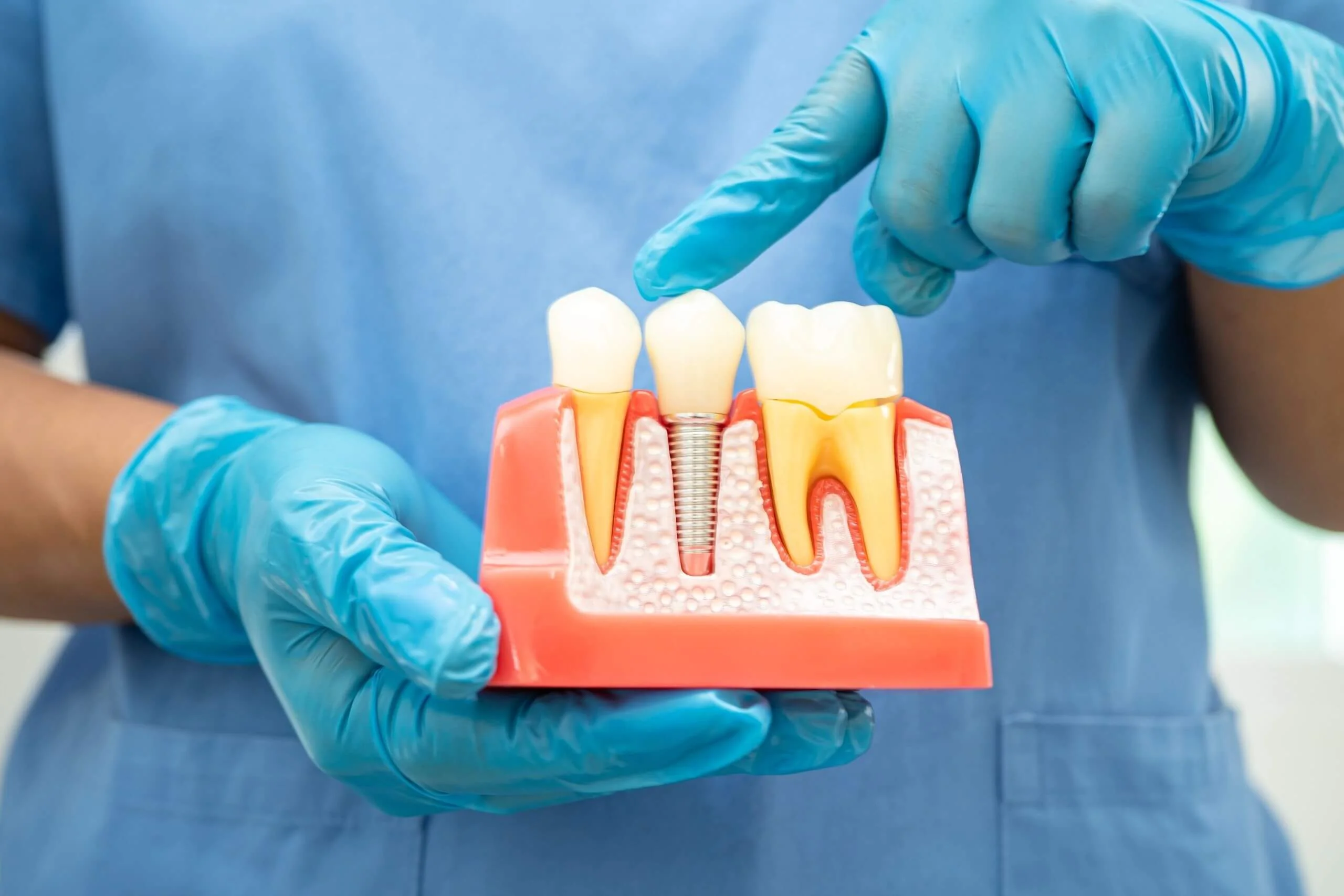 implant-sonrasi-beslenme