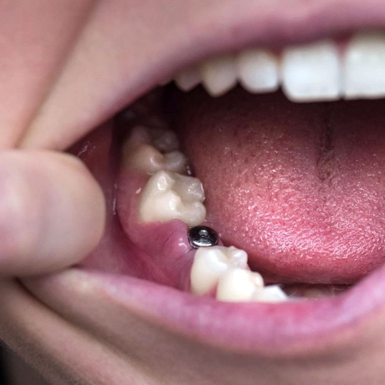 Tek-Dis-Implant-Tedavisi