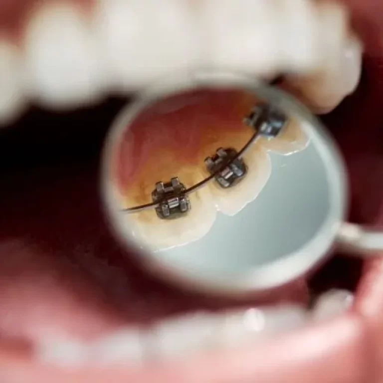 suheyla-demir-lingual-dis-teli